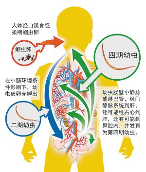 蛔虫病