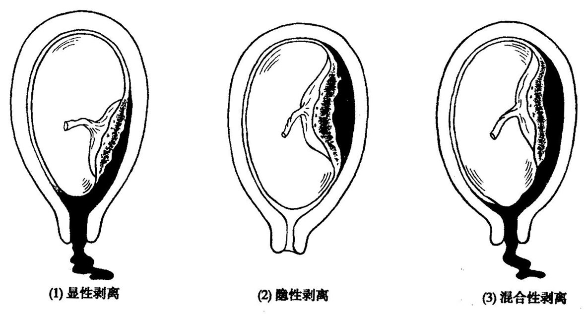 【胎盘早剥】胎盘早剥是什么_胎盘早剥怎么办_胎盘早剥怎么预防-到家月嫂