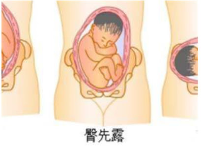 妊娠30周后经产前检查,发现臀位,横位,枕后位,颜面位等谓之胎位不正